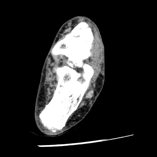 Anterior tibial artery false aneurysm (Radiopaedia 88984-105809 A 174).jpg