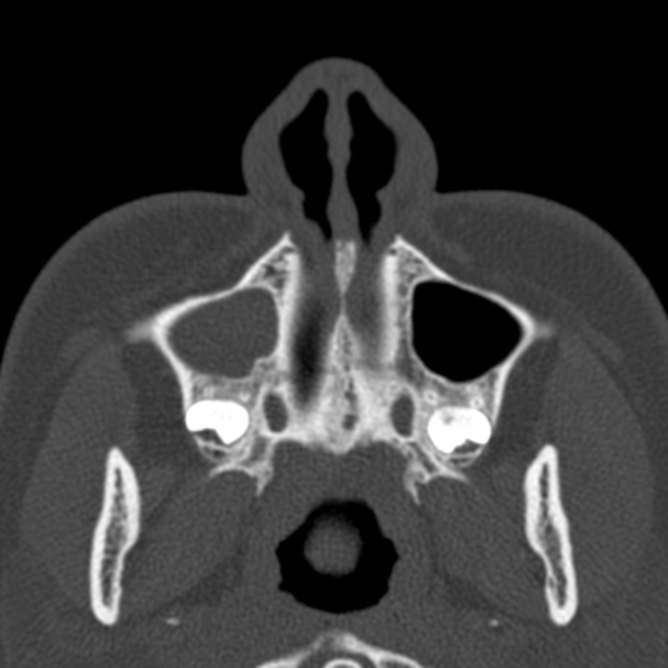 Antrochoanal polyp (Radiopaedia 33984-35202 Axial bone window 10).jpg