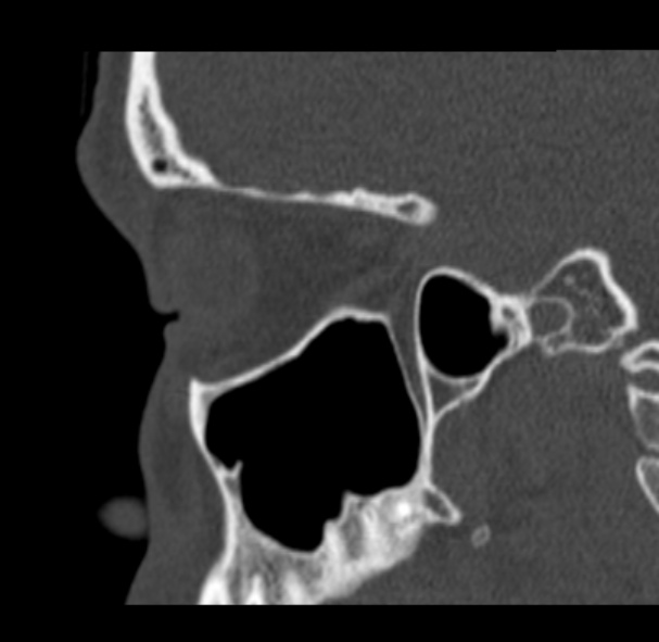 Antrochoanal polyp (Radiopaedia 33984-35202 Sagittal bone window 58).jpg