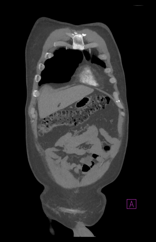 Aortectomy and axillary-bifemoral bypass (Radiopaedia 28303-28545 C 19).jpg
