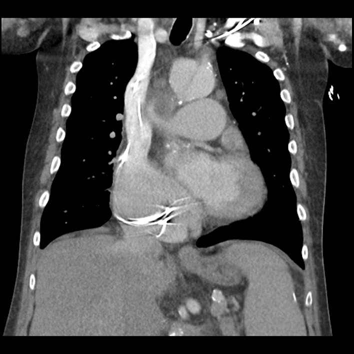 Aortic arch graft infection (FDG PET-CT) (Radiopaedia 71975-82437 Coronal 29).jpg