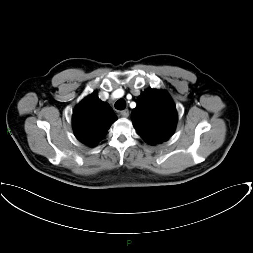 Aortic arch origin of left vertebral artery (Radiopaedia 46327-50737 Axial post contrast 22).jpg