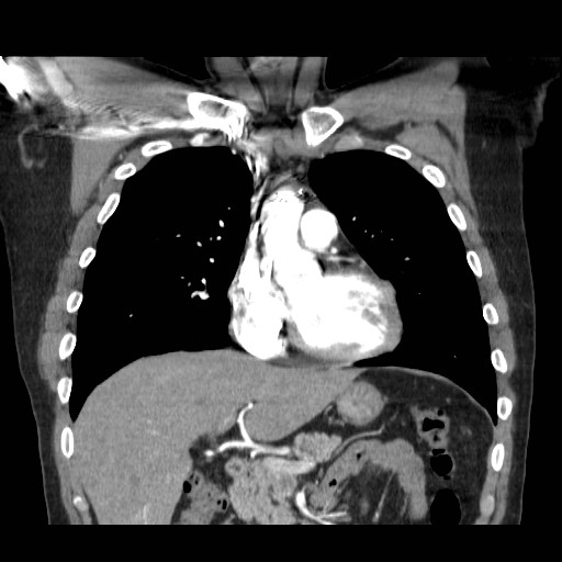 File:Aortic arch stent (Radiopaedia 30030-30595 F 6).jpg
