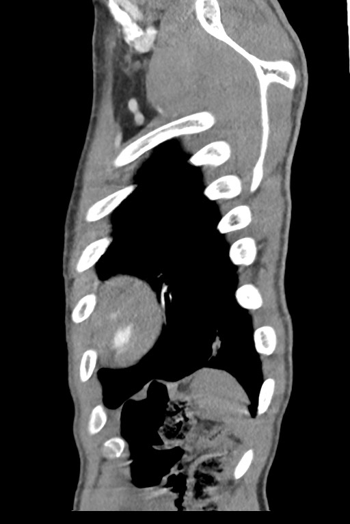 Aortic coarctation with aneurysm (Radiopaedia 74818-85828 B 141).jpg