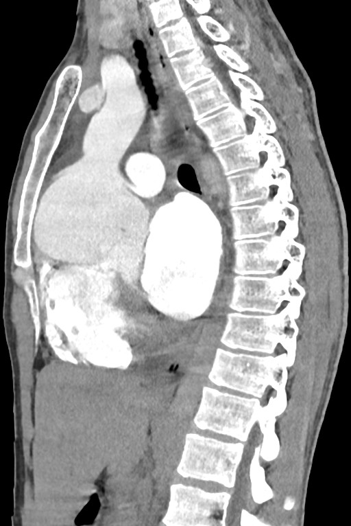 Aortic coarctation with aneurysm (Radiopaedia 74818-85828 B 86).jpg