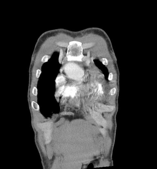 File:Aortic coarctation with aneurysm (Radiopaedia 74818-85828 C 15).jpg