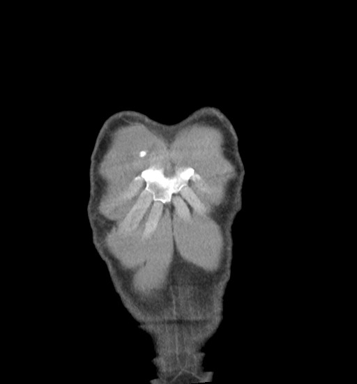 Aortic coarctation with aneurysm (Radiopaedia 74818-85828 C 6).jpg