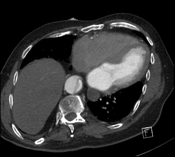 File:Aortic dissection (CTPA) (Radiopaedia 75506-86750 A 66).jpg
