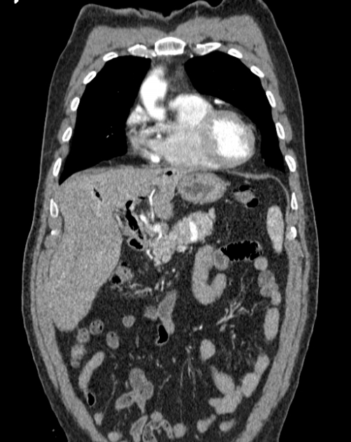 Aortic dissection (Radiopaedia 44411-48061 A 2).jpg