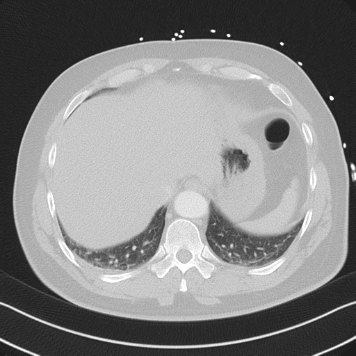 File:Aortic dissection (Radiopaedia 50763-56234 Axial lung window 53).png