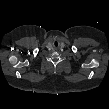 Aortic dissection (Radiopaedia 57969-64959 A 4).jpg
