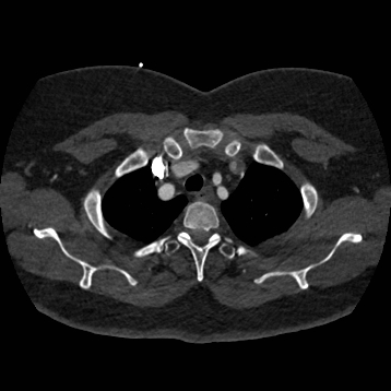 Aortic dissection (Radiopaedia 57969-64959 A 59).jpg