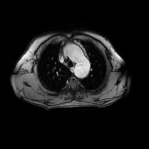File:Aortic dissection - Stanford A - DeBakey I (Radiopaedia 23469-23551 Axial MRA 7).jpg