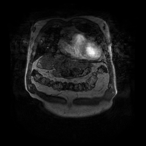 File:Aortic dissection - Stanford A - DeBakey I (Radiopaedia 23469-23551 D 30).jpg