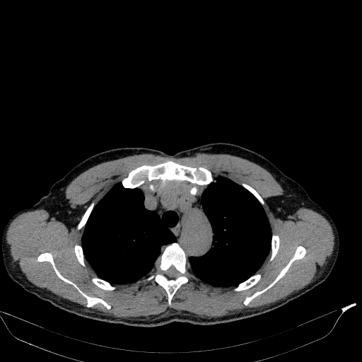 Aortic dissection - Stanford type A (Radiopaedia 83418-98500 Axial non-contrast 9).jpg