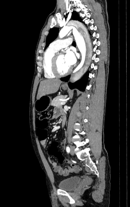 Aortic dissection - Stanford type A (Radiopaedia 83418-98500 B 48).jpg