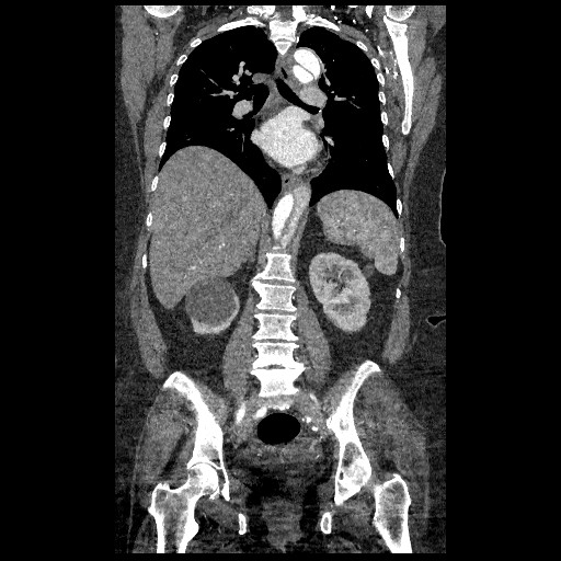 File:Aortic dissection - Stanford type B (Radiopaedia 88281-104910 B 48).jpg