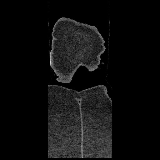Aortic dissection - Stanford type B (Radiopaedia 88281-104910 B 98).jpg