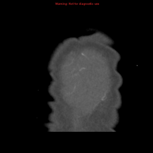 File:Aortic ductus diverticulum (Radiopaedia 8339-9180 B 85).jpg