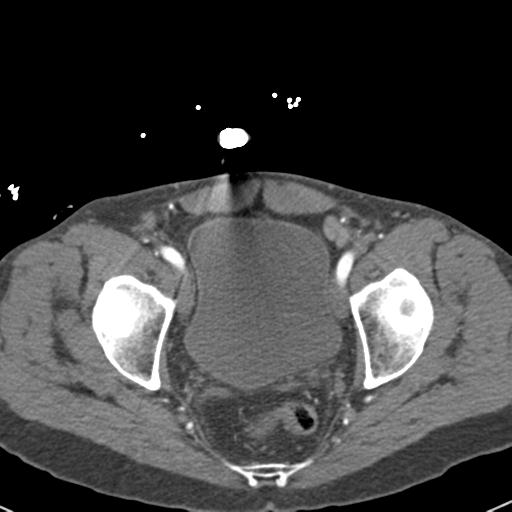 Aortic intramural hematoma (Radiopaedia 31139-31838 B 157).jpg