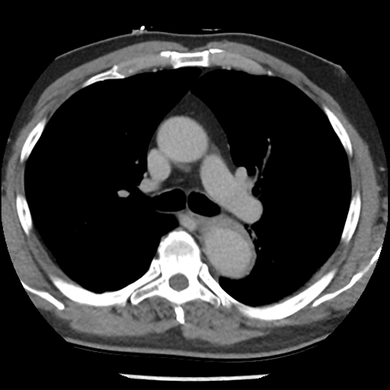 Aortic intramural hematoma (type B) (Radiopaedia 79323-92387 Axial C+ delayed 20).jpg