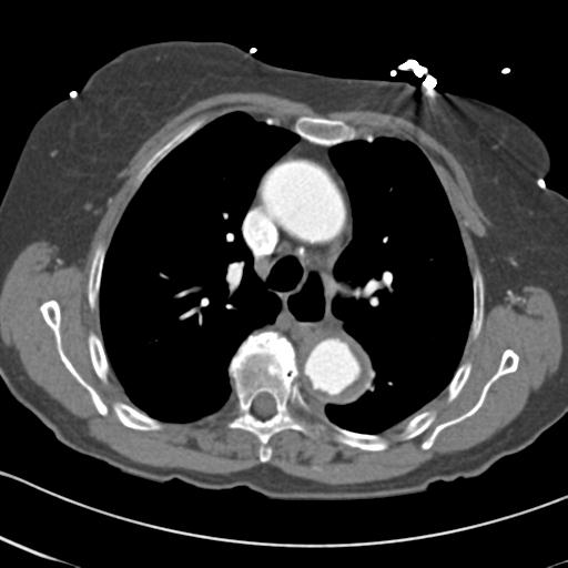 File:Aortic intramural hematoma from penetrating atherosclerotic ulcer (Radiopaedia 31137-31836 A 28).jpg