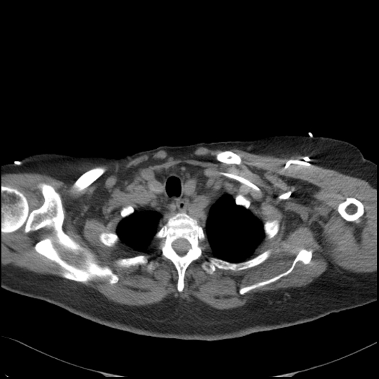 File:Aortic intramural hematoma with dissection and intramural blood pool (Radiopaedia 77373-89491 Axial non-contrast 16).jpg