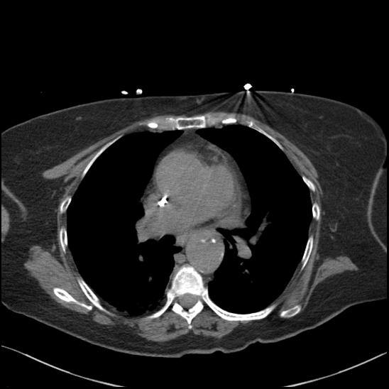 Aortic intramural hematoma with dissection and intramural blood pool (Radiopaedia 77373-89491 Axial non-contrast 45).jpg