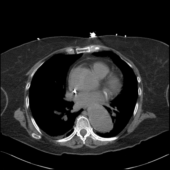 File:Aortic intramural hematoma with dissection and intramural blood pool (Radiopaedia 77373-89491 Axial non-contrast 55).jpg