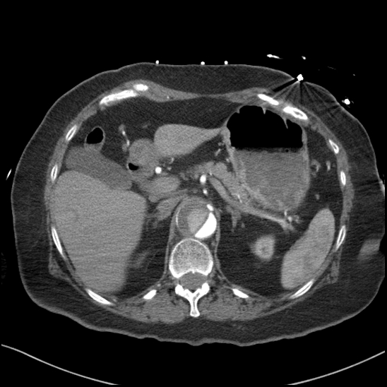 Aortic intramural hematoma with dissection and intramural blood pool (Radiopaedia 77373-89491 B 110).jpg