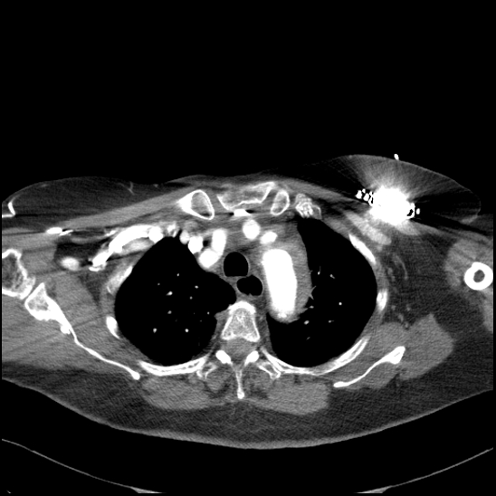 Aortic intramural hematoma with dissection and intramural blood pool (Radiopaedia 77373-89491 B 36).jpg