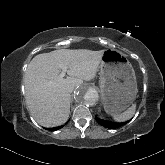File:Aortic intramural hematoma with dissection and intramural blood pool (Radiopaedia 77373-89491 E 1).jpg