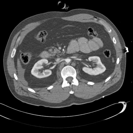 Aortic transection, diaphragmatic rupture and hemoperitoneum in a complex multitrauma patient (Radiopaedia 31701-32622 A 106).jpg