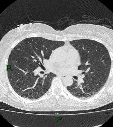 File:Aortic valve endocarditis (Radiopaedia 87209-103485 Axial lung window 52).jpg