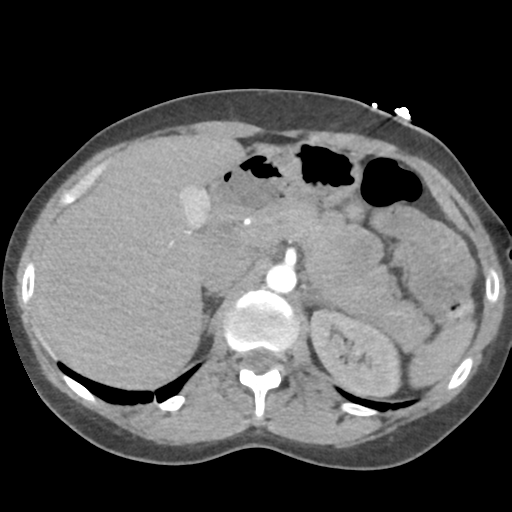File:Aortic valve non-coronary cusp thrombus (Radiopaedia 55661-62189 B 53).png