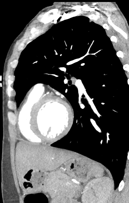 Aortic valve non-coronary cusp thrombus (Radiopaedia 55661-62189 C+ arterial phase 16).png