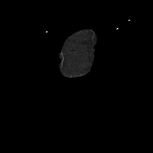 Aortocaval fistula (Radiopaedia 80280-93625 B 10).jpg