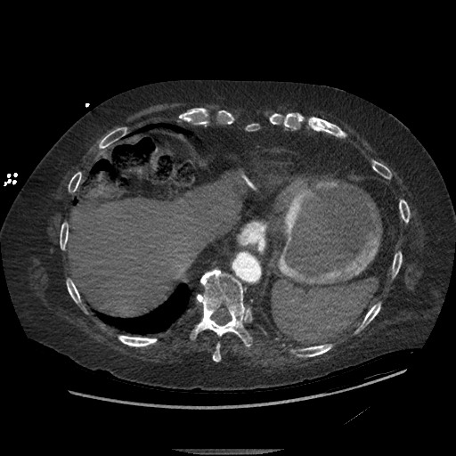 Aortoesophageal fistula with endovascular repair (Radiopaedia 73781-84592 Axial C+ CTPA 143).jpg