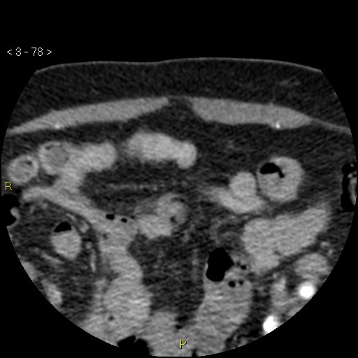 Aortoiliac occlusive disease (Radiopaedia 16828-16548 A 78).jpg