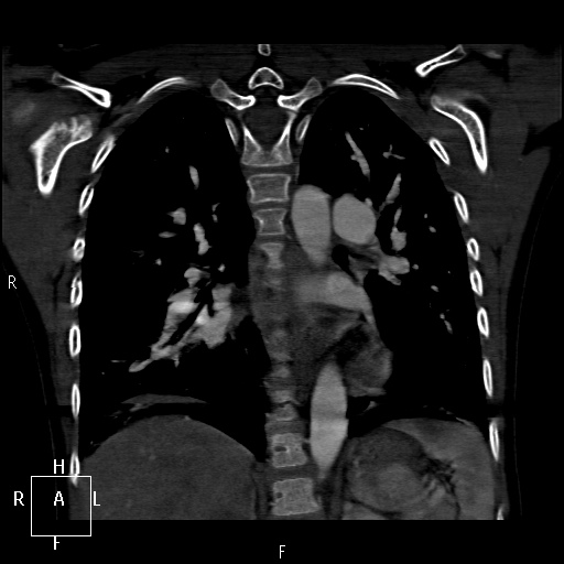 File:Aortopulmonary septal defect (Radiopaedia 41990-45013 Coronal C+ CTPA 45).jpg