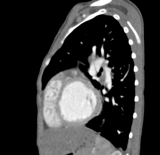 File:Aortopulmonary window, interrupted aortic arch and large PDA giving the descending aorta (Radiopaedia 35573-37074 C 37).jpg