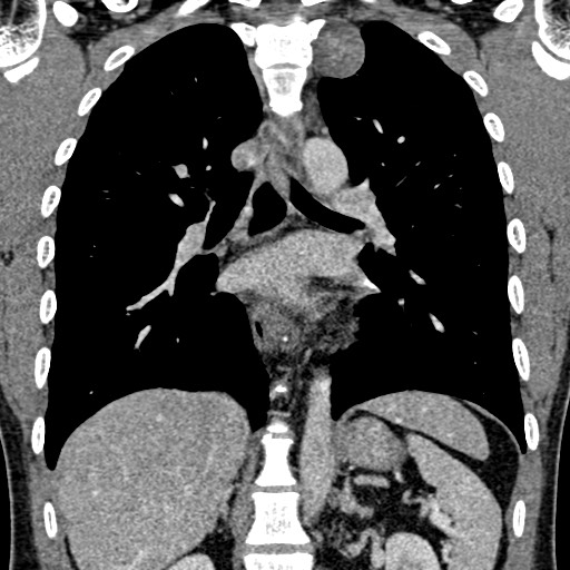 Apical lung mass mimic - neurogenic tumor (Radiopaedia 59918-67521 B 69).jpg