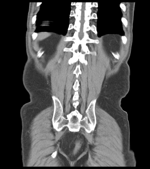 File:Appendiceal abscesses (Radiopaedia 50999-56542 Coronal non-contrast 48).png