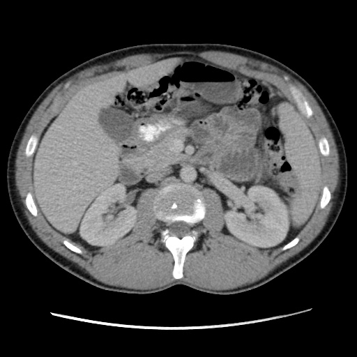 Appendicitis complicated by post-operative collection (Radiopaedia 35595-37114 A 32).jpg