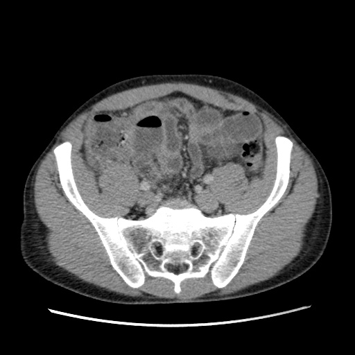 File:Appendicitis complicated by post-operative collection (Radiopaedia 35595-37114 A 64).jpg