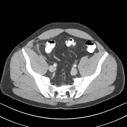 Appendicitis with cecal bar sign (Radiopaedia 31878-32830 B 63).jpg