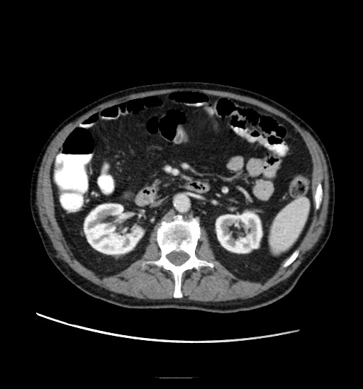 Appendicitis with localized perforation and abscess formation (Radiopaedia 49035-54130 A 39).jpg