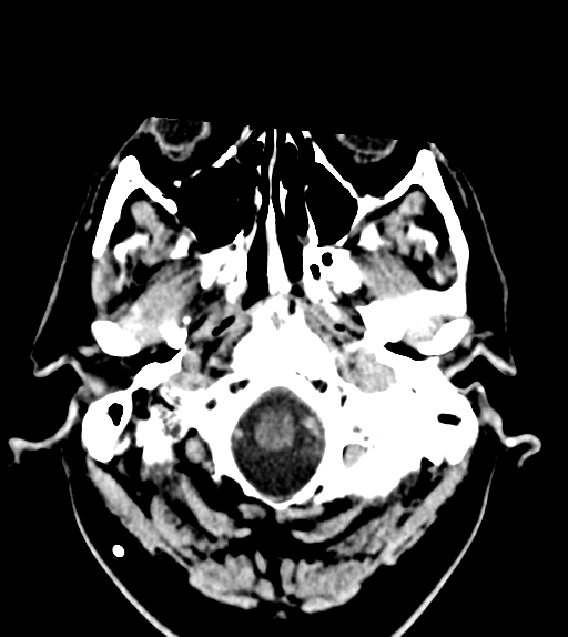 File:Aqueduct stenosis with corpus callosum hypoattenuation post shunting (Radiopaedia 37212-38971 Axial non-contrast 2).png