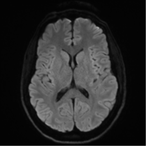 Arachnoid cyst - cerebellopontine angle (Radiopaedia 59689-67083 Axial DWI 56).png