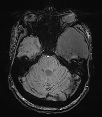 Arachnoid cyst with subdural hematoma (Radiopaedia 85892-101743 Axial SWI 23).png
